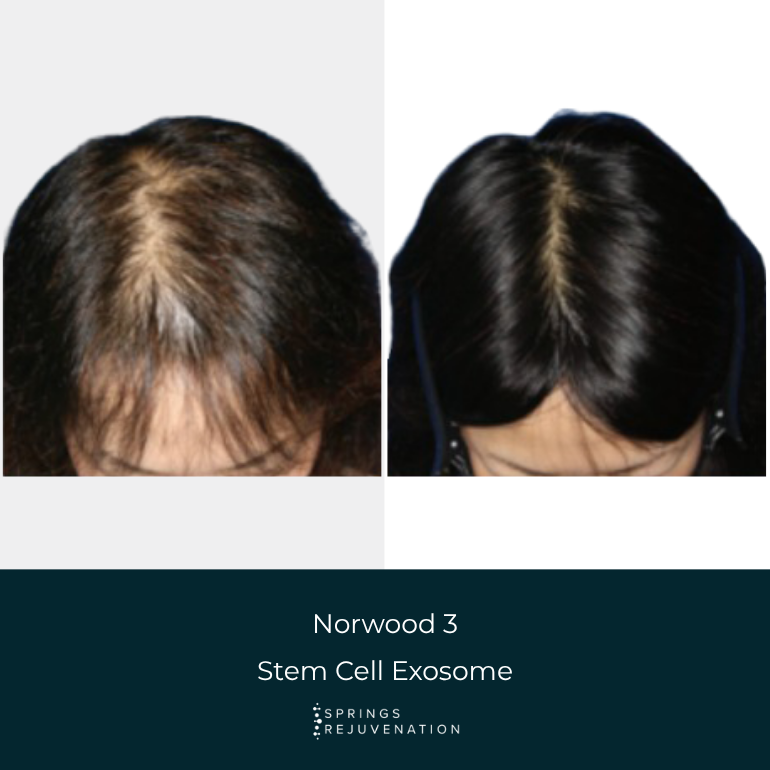 Before and After Results